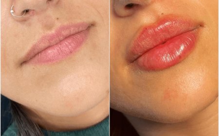 What is the Duration of Juvederm Results? Tips from the Best Plastic Surgeons in Dubai