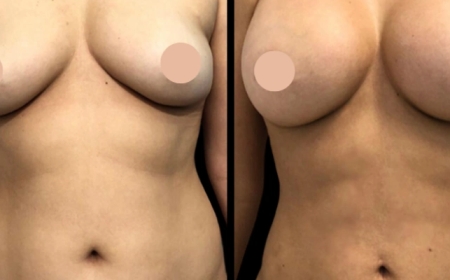 Best Breast Augmentation Surgeon in Dubai According to Patients