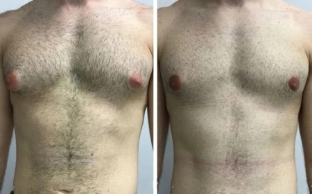 Top Qualities of the Best Gynecomastia Surgeons in Dubai