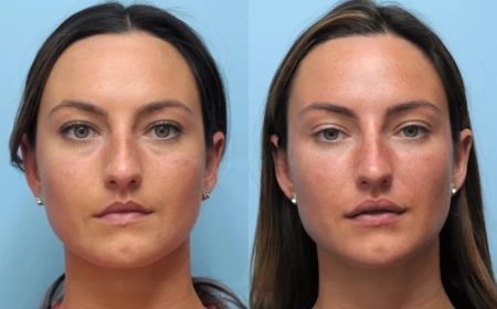 Achieve Instant Lift with a Thread Lift in Dubai