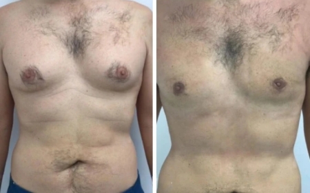 How to Choose the Best Doctor for Gynecomastia in Dubai