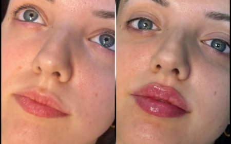 Best Doctors in Dubai for Fillers: What You Should Expect Before, During, and After