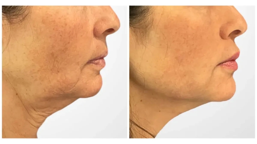 Before and After: Real Results from Thread Lift in Dubai