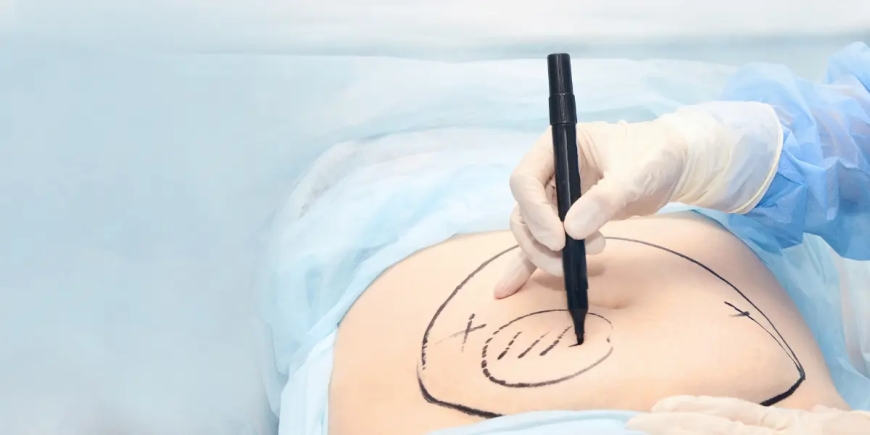 Abdominoplasty in Dubai: The Benefits of Abdominoplasty for Body Contouring and Sculpting