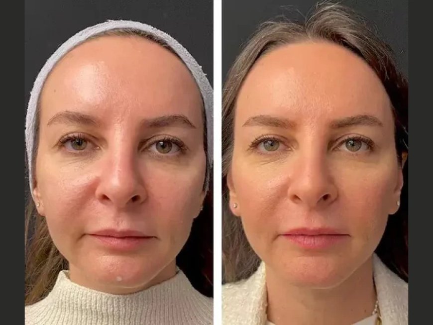 Top Anti-Aging Benefits of Mesotherapy with the Best Plastic Surgeon in Dubai