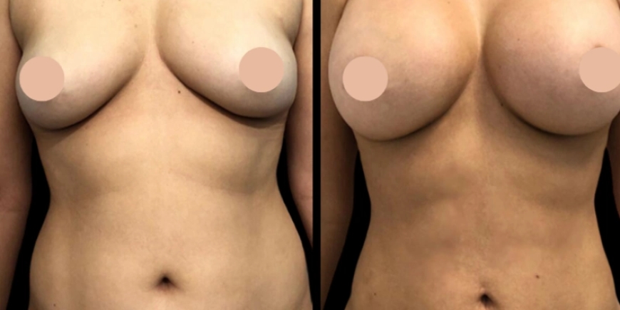 Best Breast Augmentation Surgeon in Dubai According to Patients
