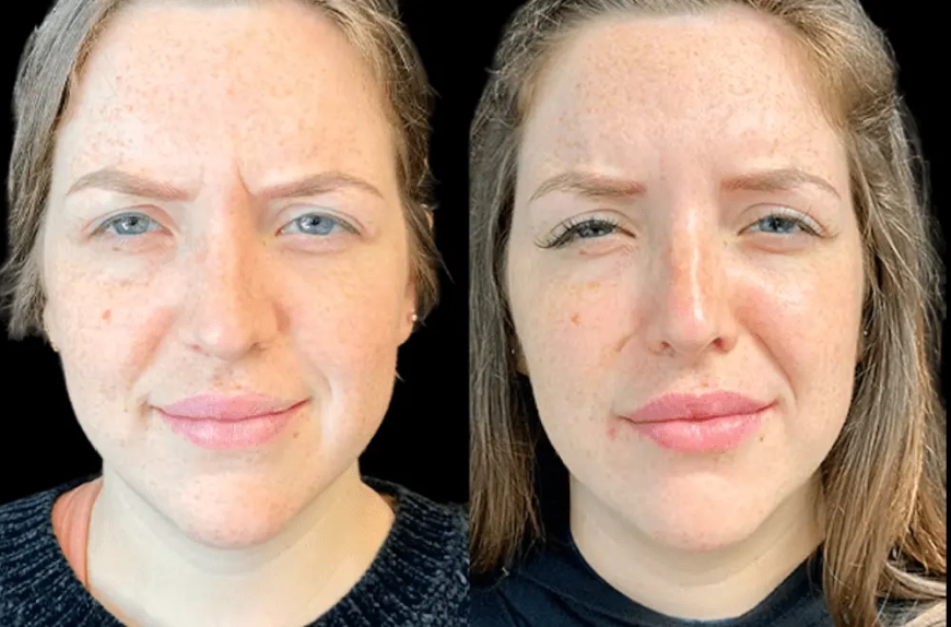 The Best Plastic Surgeon in dubai Shares What to Expect After Your First Botox