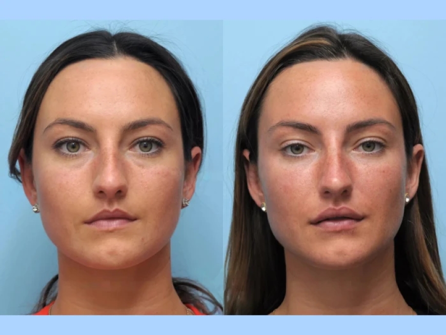 The Rise of Thread Lift Treatment in Dubai’s Aesthetic Clinics
