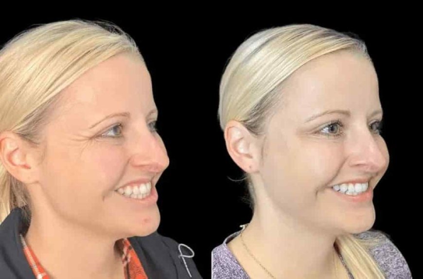 The Rise of Botox Treatment in Dubai’s Luxury Aesthetic Scene