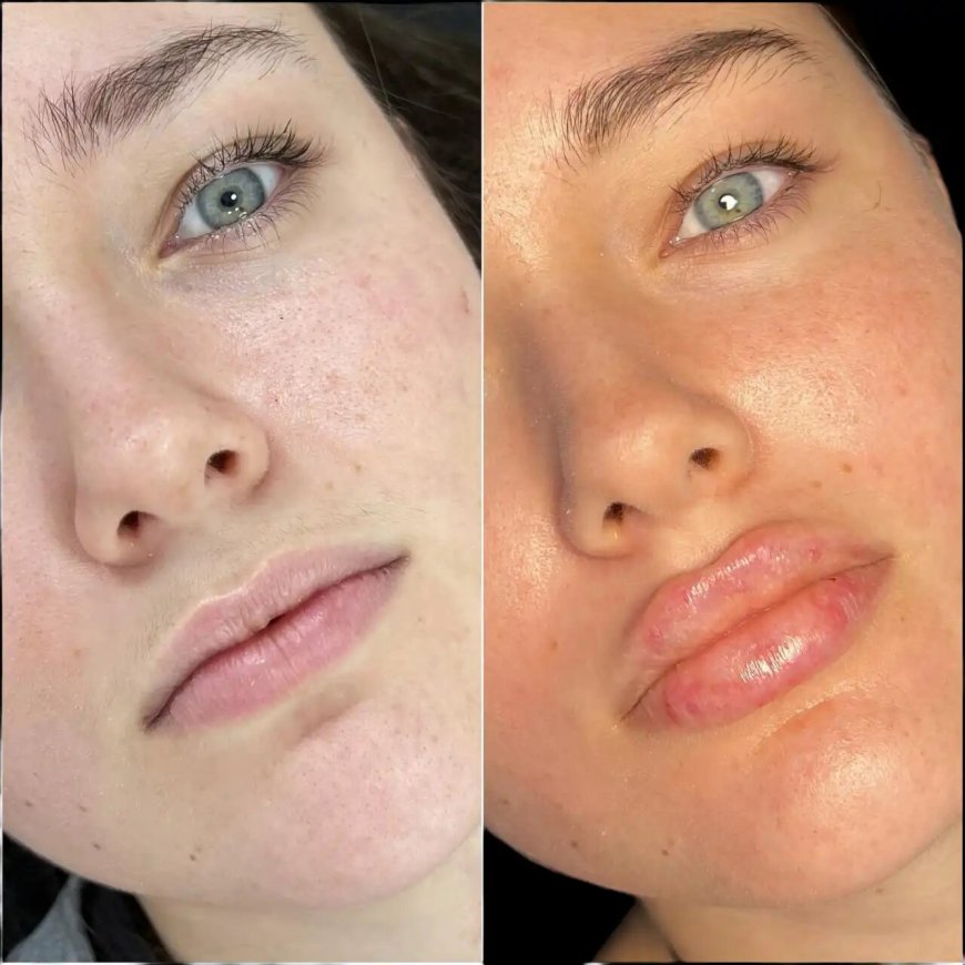 Fillers Treatment in Dubai: How to Prepare Your Skin