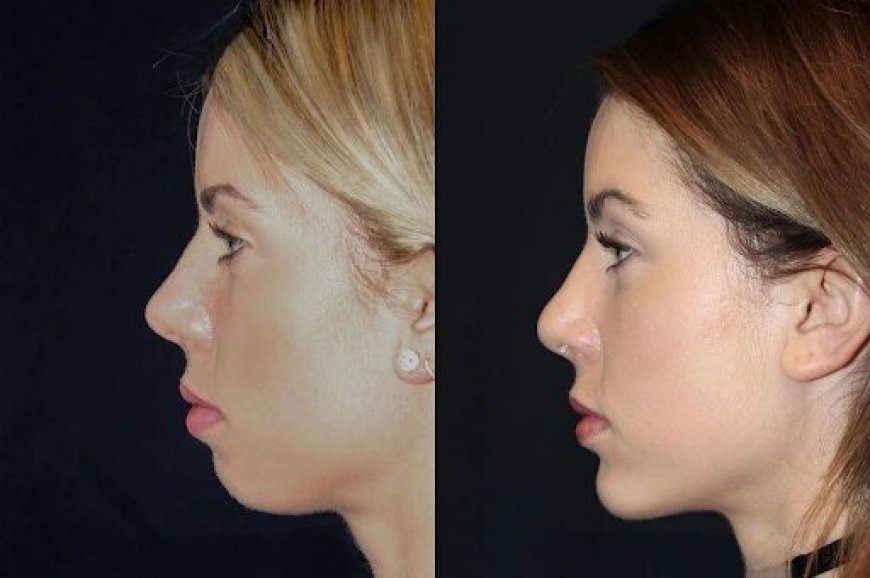 Chin Fillers Treatment in Dubai: Enhancing Your Confidence