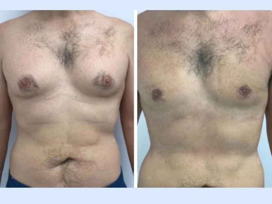 How to Choose the Best Doctor for Gynecomastia in Dubai
