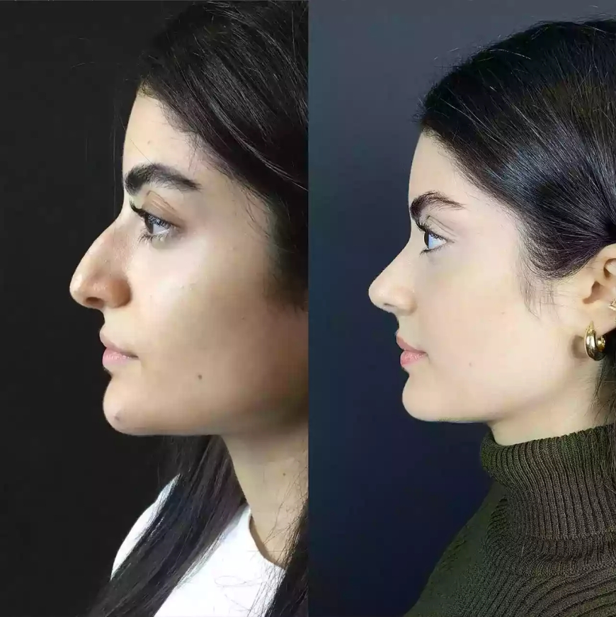 Best Season to Have Rhinoplasty in Dubai