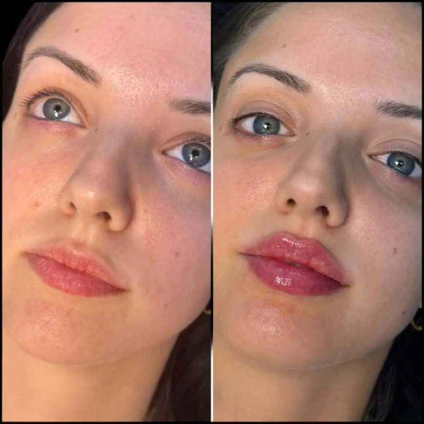 Best Doctors in Dubai for Fillers: What You Should Expect Before, During, and After