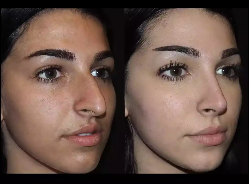 Combining Septoplasty and Rhinoplasty in Dubai: What’s Involved?