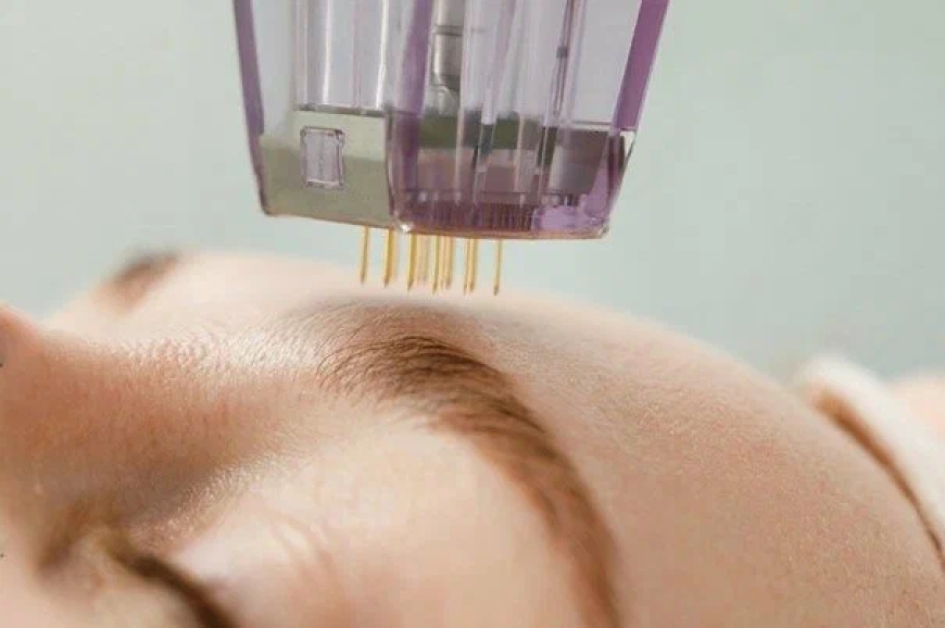 Unlock Radiant Skin: Finding the Best Microneedling Near Me