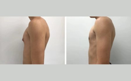 Recovery After Gynecomastia Surgery: A Dubai Surgeon’s Guide