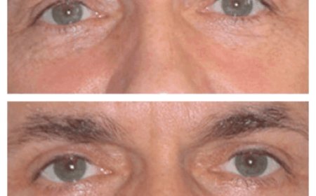 Eye bag removal in Dubai: How long do results last?