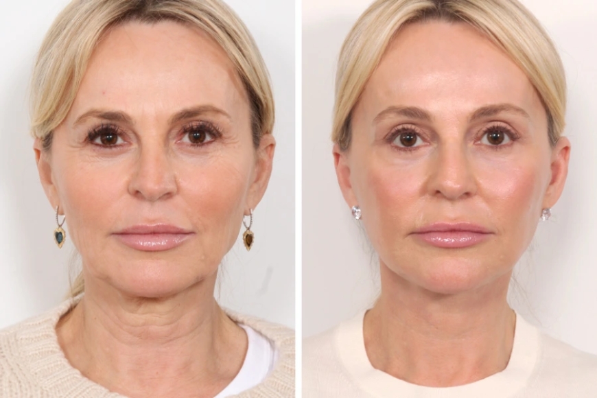 Best Aesthetic Clinics in Dubai for Thread Lift: What to Expect and Where to Go