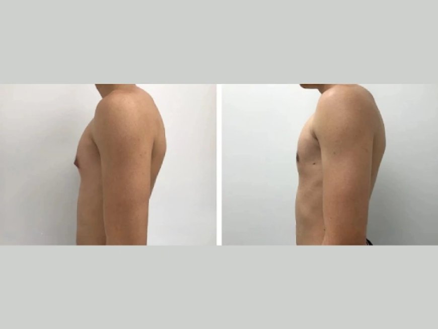 Recovery After Gynecomastia Surgery: A Dubai Surgeon’s Guide