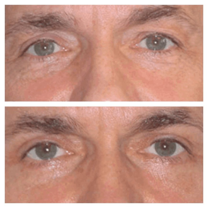 Eye bag removal in Dubai: How long do results last?