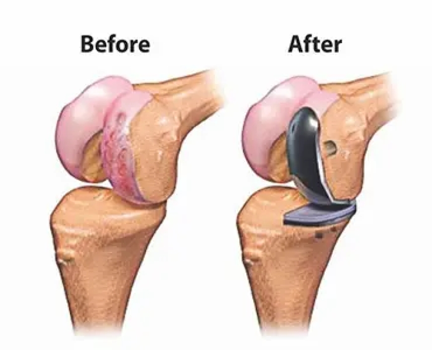 Total vs. Partial Knee Replacement: Which One Do You Need?