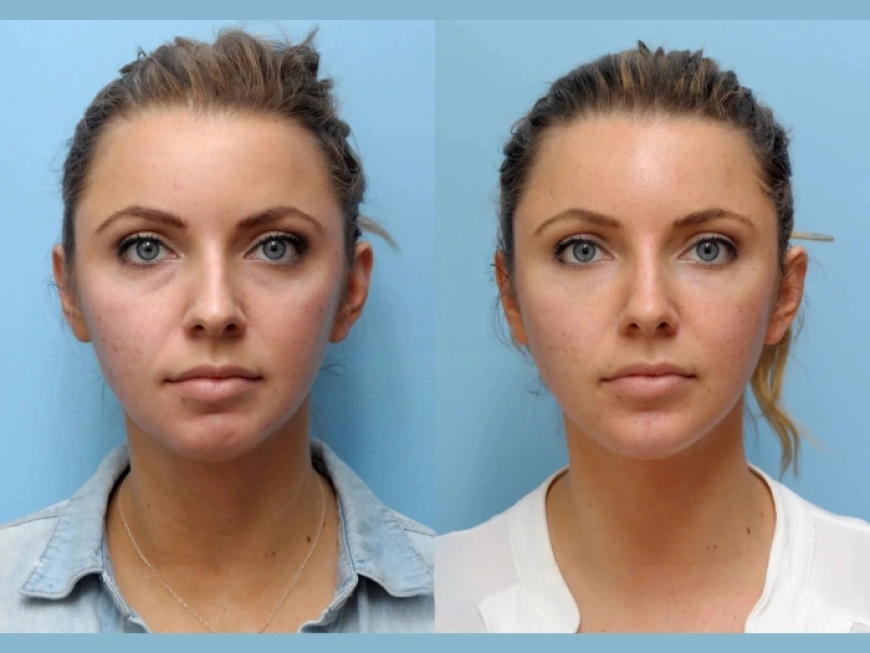 How Thread Lift Treatments in Dubai Can Restore a Youthful, Sculpted Look