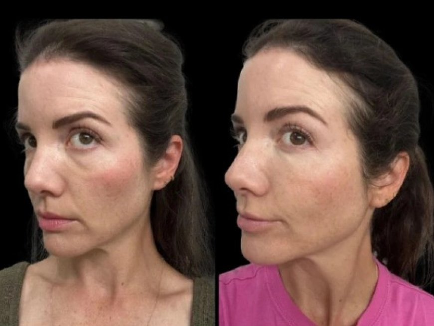 Dark Circles Treatments in Dubai: Combining Treatments for the Best Results